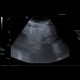 Mesenteric lipodystrophy, paniculitis: US - Ultrasound